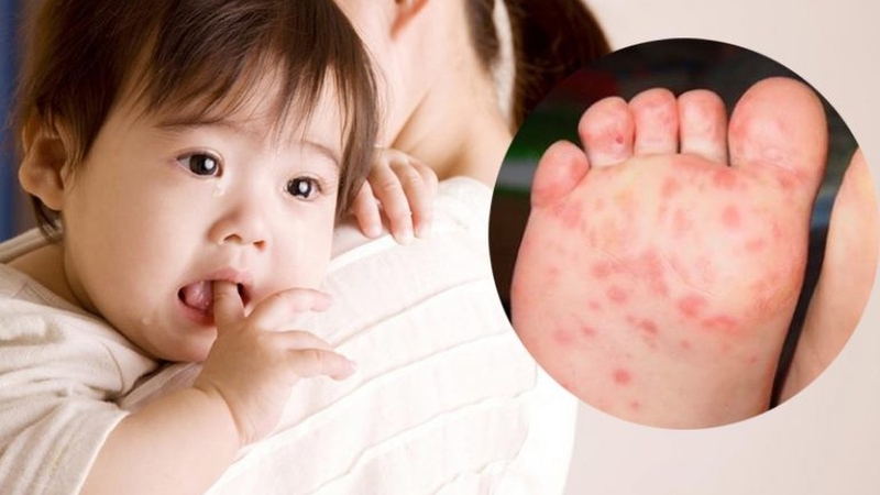Vì sao trẻ bị sốt lòng bàn tay chân nóng? Nguyên nhân, cách chăm sóc và phòng ngừa 1