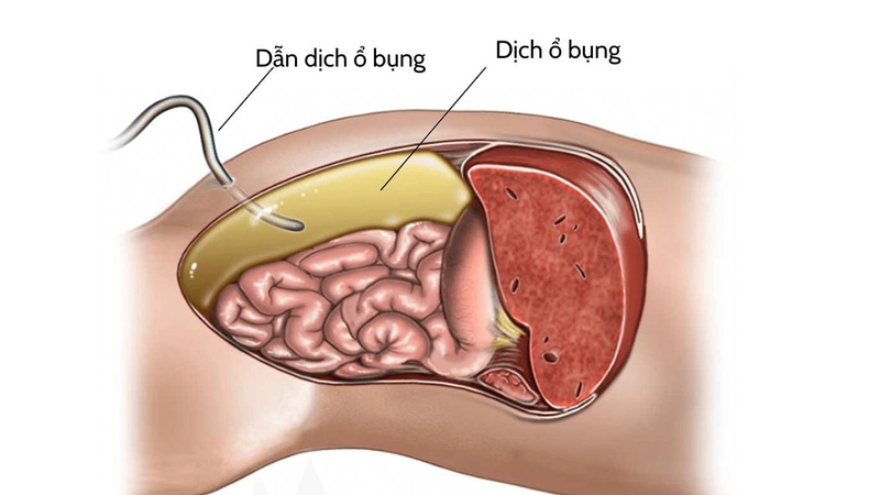 Bác sĩ dùng siêu âm xác định vị trí phù hợp trước khi chọc dịch ổ bụng