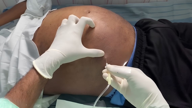 Người bệnh được theo dõi trong và sau khi hoàn tất chọc tháo dịch