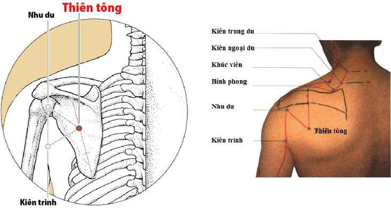 Vị trí huyệt Thiên Tông và cách xác định vị trí huyệt1