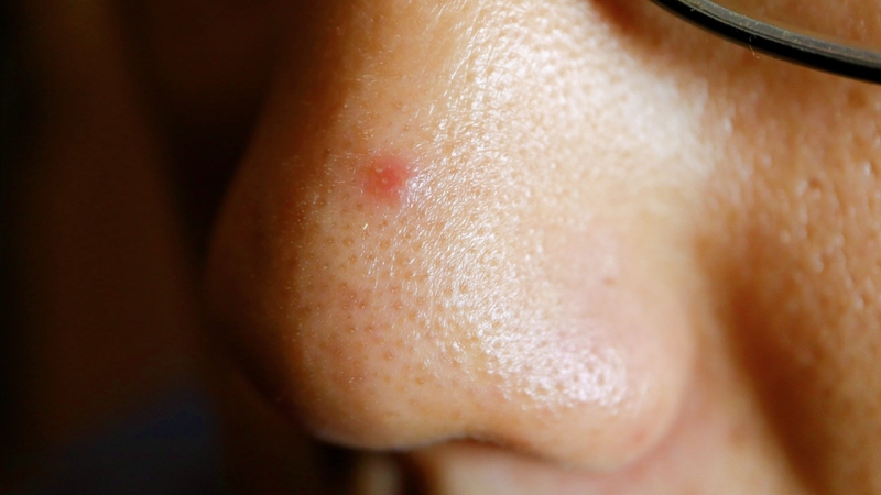 Mụn ở vùng mũi thường liên quan đến tăng tiết bã nhờn