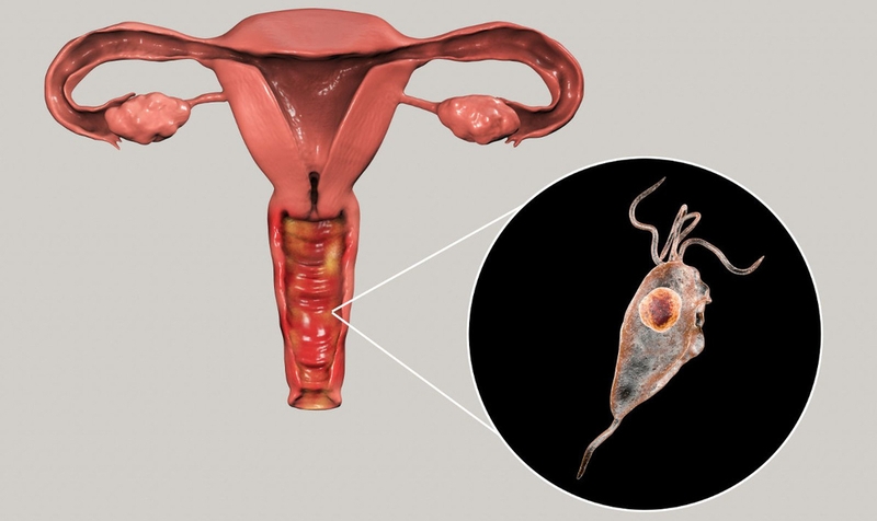 Viêm âm đạo dùng thuốc gì? Cách sử dụng thuốc hiệu quả và phổ biến nhất 2