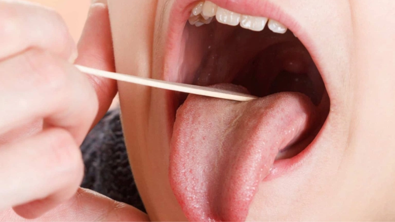 Viêm amidan 1 bên - Cách nhận biết và điều trị 1