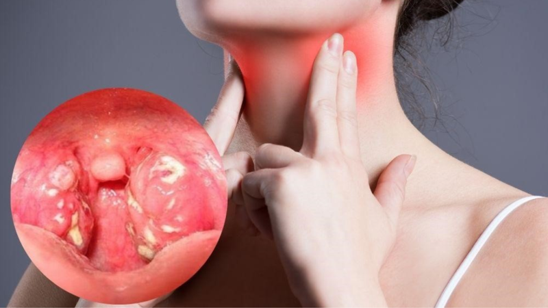 Viêm amidan 1 bên - Cách nhận biết và điều trị 2