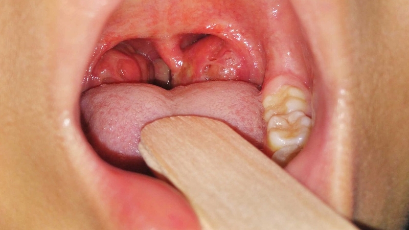 Viêm amidan nên làm gì để giảm đau và sớm phục hồi? - 1