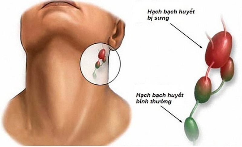 Viêm amidan nổi hạch có nguy hiểm không?