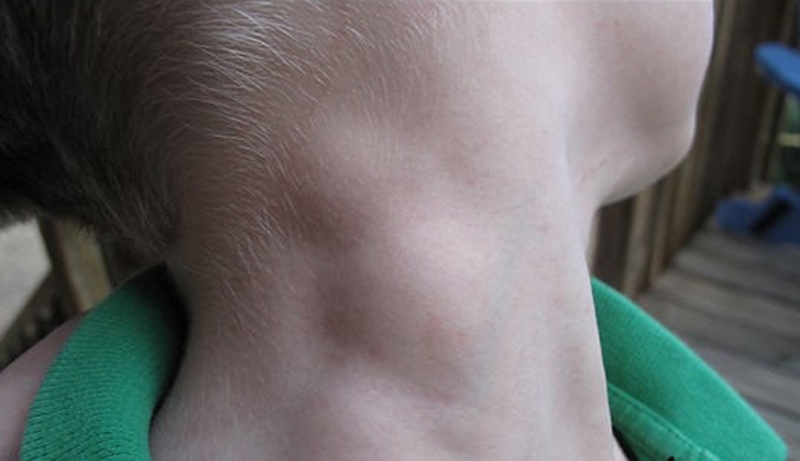 Viêm amidan nổi hạch có nguy hiểm không?