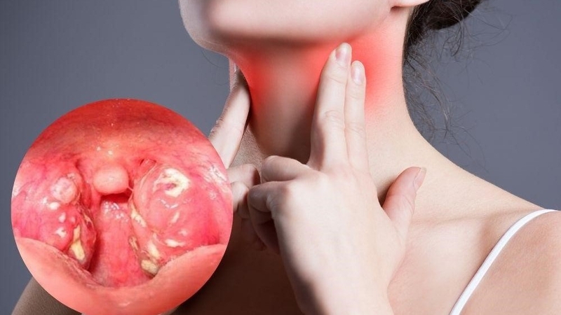 Viêm amidan ở người lớn: Ít gặp nhưng chớ chủ quan! 6