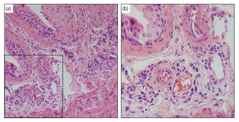 Hình ảnh bàng quang xơ hóa