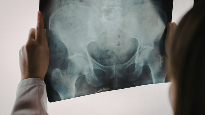 Viêm bao hoạt dịch ụ ngồi ở mông nên được chẩn đoán và điều trị kịp thời