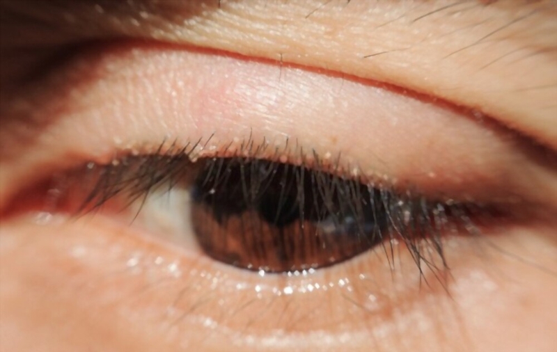 Người mổ chắp mắt bao lâu thì khỏi hẳn? 2