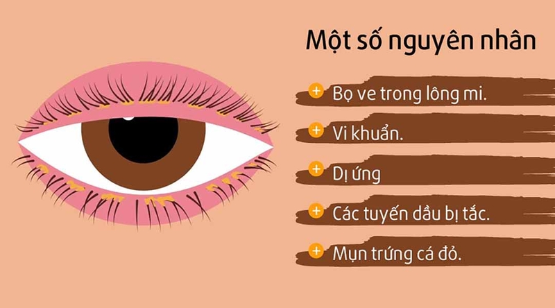 Viêm bờ mi bao lâu thì khỏi? Những điều cần biết về viêm bờ mi 1