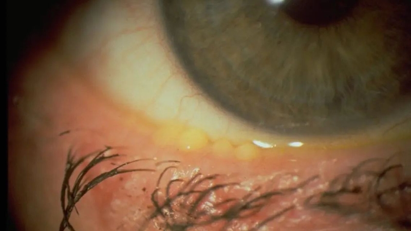 Nên tìm hiểu nguyên nhân và yếu tố nguy cơ gây viêm bờ mi để phòng ngừa