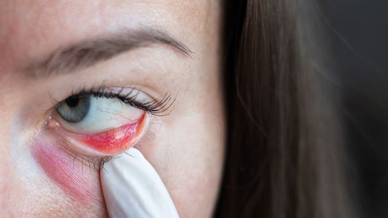 Viêm bờ mi tái phát nhiều lần có thể ảnh hưởng đến mắt lâu dài