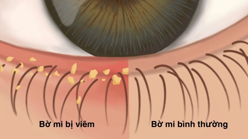 Viêm bờ mi dưới&nbsp;gây khó chịu và ảnh hưởng đến sinh hoạt hàng ngày