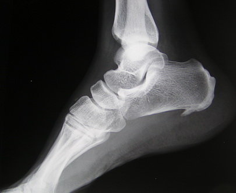 Viêm cân gan chân bao lâu thì khỏi ? Bệnh viện nào tại TPHCM có thể điều trị viêm cân gan chân lâu năm 2