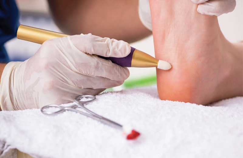 Viêm cân gan chân bao lâu thì khỏi ? Bệnh viện nào tại TPHCM có thể điều trị viêm cân gan chân lâu năm 3