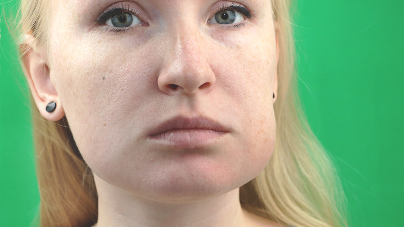 Viêm cơ gò má: Nguyên nhân, triệu chứng và cách điều trị 3