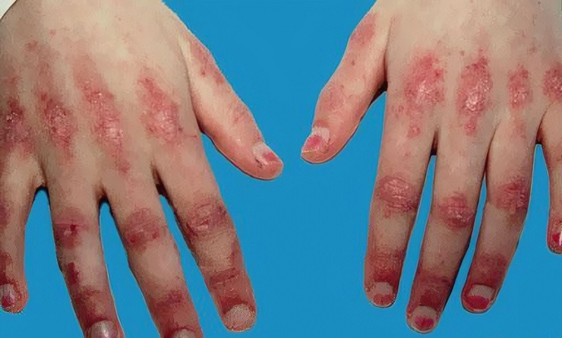 Viêm cơ tự miễn có nguyên nhân do đâu? Triệu chứng, chẩn đoán và điều trị 1