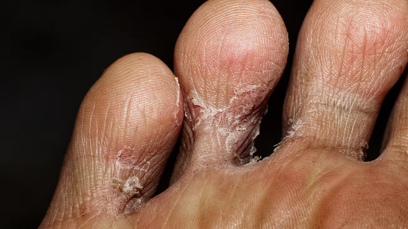 Viêm da bong vảy: Dấu hiệu nhận biết và 3 biến chứng nguy hiểm 2