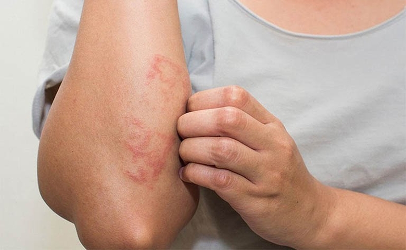 Chàm và viêm da cơ địa có giống nhau không? 3