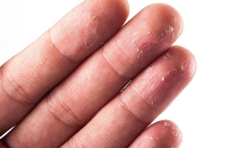 Viêm da cơ địa mất vân tay: Nguyên nhân, triệu chứng và cách điều trị 2