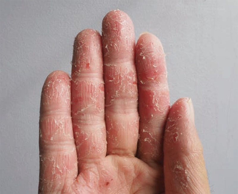 Viêm da cơ địa mất vân tay: Nguyên nhân, triệu chứng và cách điều trị 1