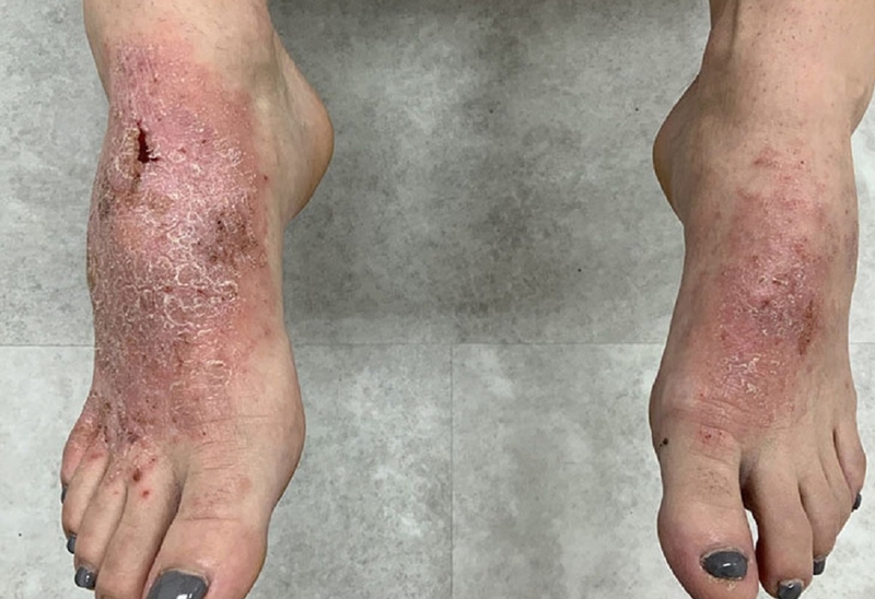 Viêm da cơ địa ở chân là gì? Cách nhận biết và điều trị bằng Đông y 3