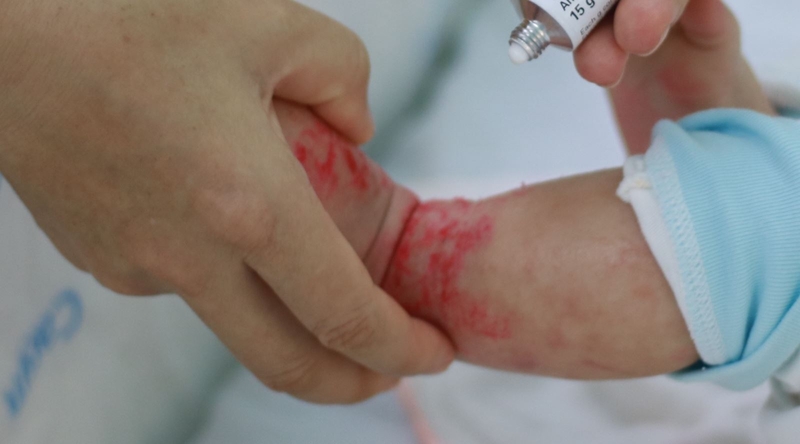 Viêm da cơ địa ở trẻ sơ sinh có đáng lo không và điều trị như thế nào? 3