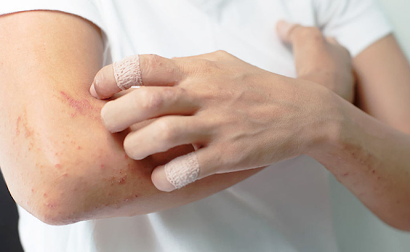 Nguyên nhân viêm da cơ địa tái đi tái lại