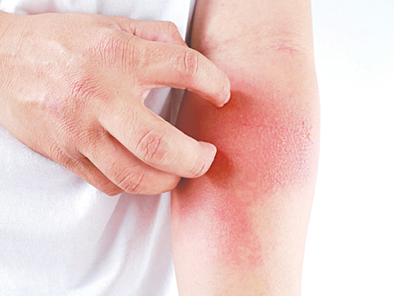 Nguyên nhân viêm da cơ địa tái phát