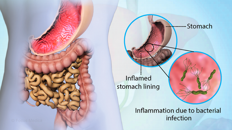 Viêm dạ dày mạn tính là gì? Nguyên nhân, triệu chứng và cách điều trị 4