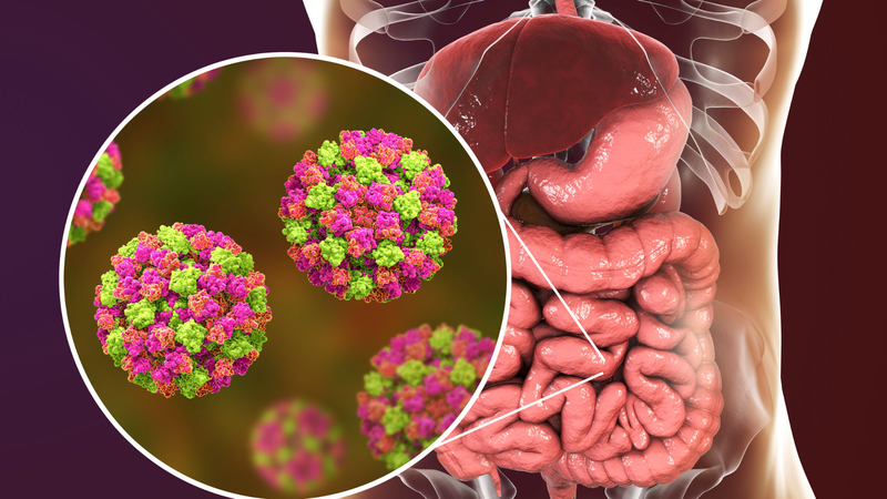 Viêm dạ dày ruột cấp tính thường do virus, vi khuẩn hoặc ký sinh trùng gây ra