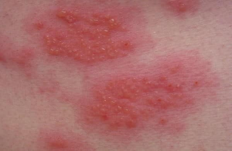 Chàm bội nhiễm có lây không? 3