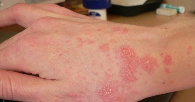 Bệnh viêm da dị ứng người già rất dễ mắc phải-3