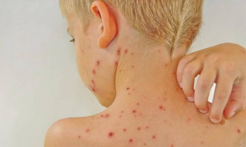 Giải đáp thắc mắc: Dị ứng da tắm lá gì để nhanh khỏi 1