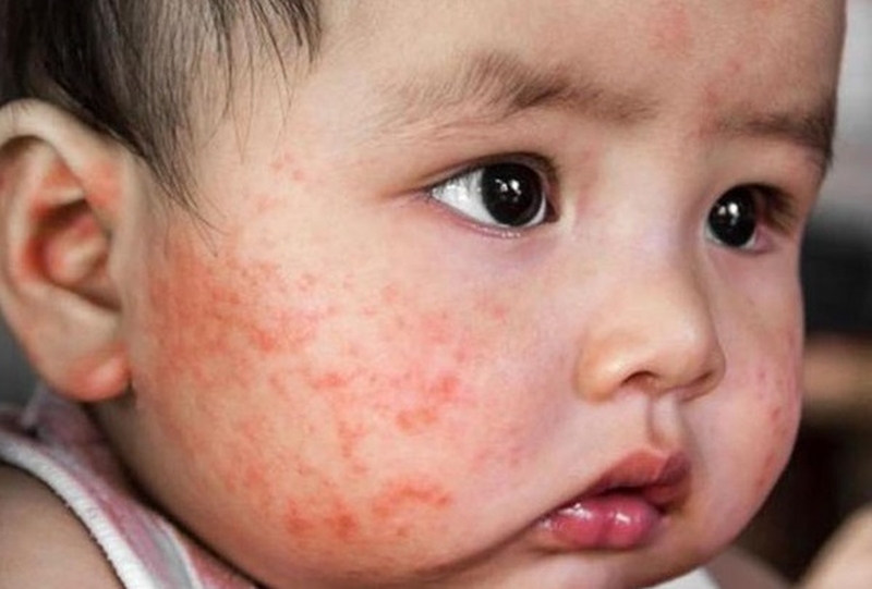 Có nên trị dị ứng da mặt bằng lòng trắng trứng gà? 1