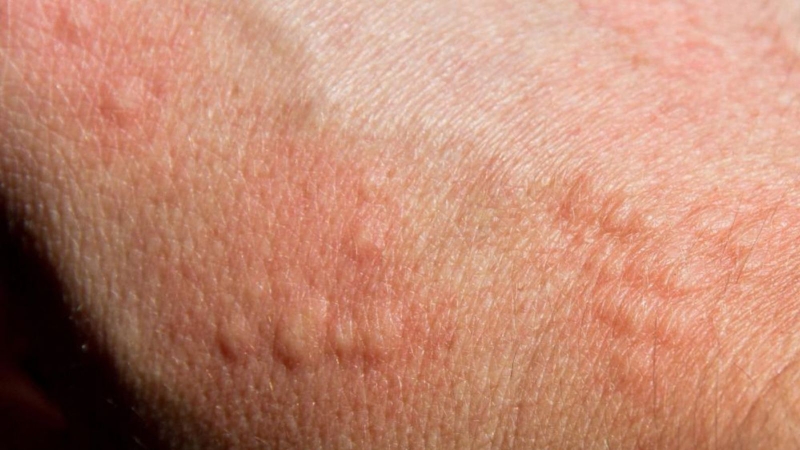 Viêm da dị ứng thời tiết có chữa hết không? 4