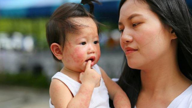 Viêm da dị ứng thời tiết ở trẻ nhỏ: Dấu hiệu nhận biết và cách xử lý hiệu quả 1