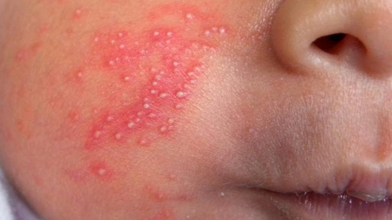 Hiện tượng viêm da mủ ở trẻ sơ sinh