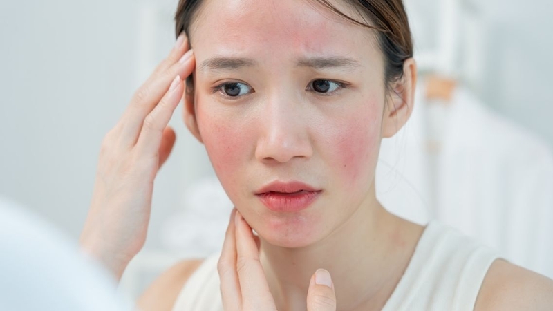 Triệu chứng viêm da tiếp xúc ánh sáng khác nhau tùy từng mức độ