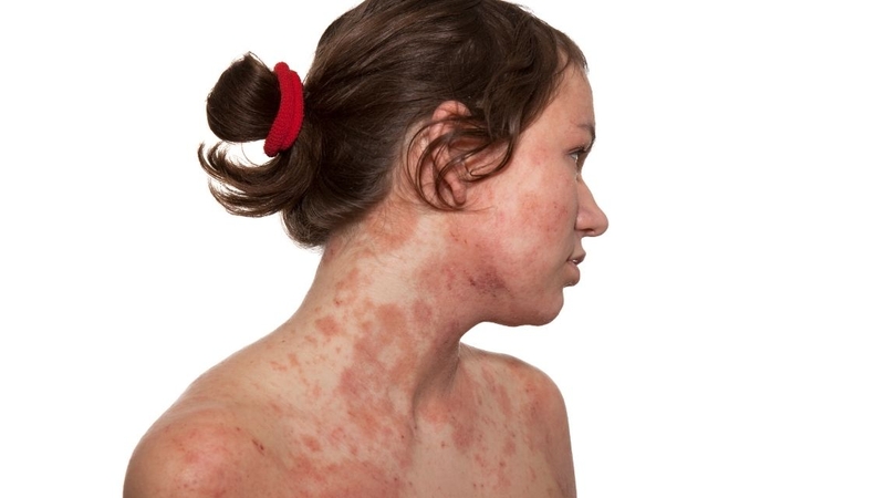 Nhiều người bị ảnh hưởng bởi bệnh&nbsp;viêm da tiếp xúc ánh sáng