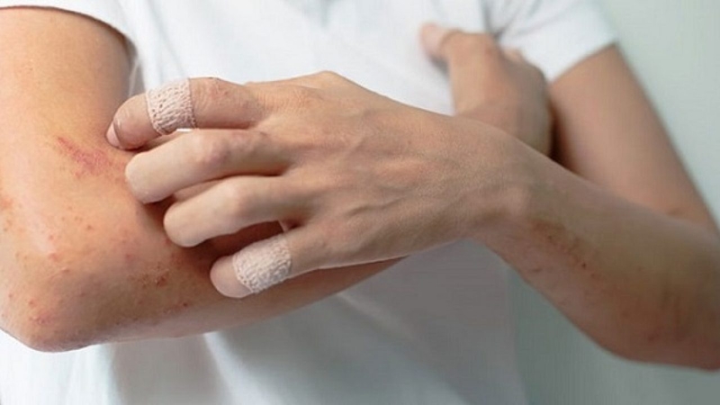 Viêm da tiếp xúc có lây không? Phương pháp điều trị viêm da tiếp xúc 3