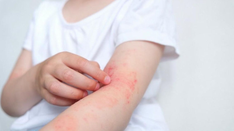 Tìm hiểu chi tiết về bệnh viêm da tiếp xúc ở trẻ 2