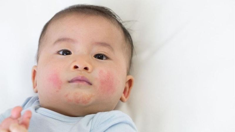 Tìm hiểu chi tiết về bệnh viêm da tiếp xúc ở trẻ 3