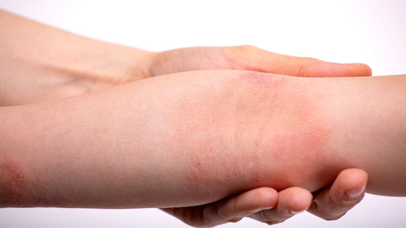 Viêm da tiếp xúc và viêm da cơ địa: Cách phân biệt và hướng xử trí hiệu quả 4
