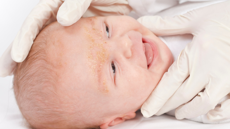 Viêm da tiết bã ở trẻ sơ sinh: Triệu chứng và cách điều trị 1