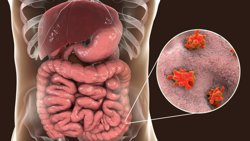 Viêm đại tràng cấp tính có nguy hiểm không? Triệu chứng và nguyên nhân gây bệnh 3