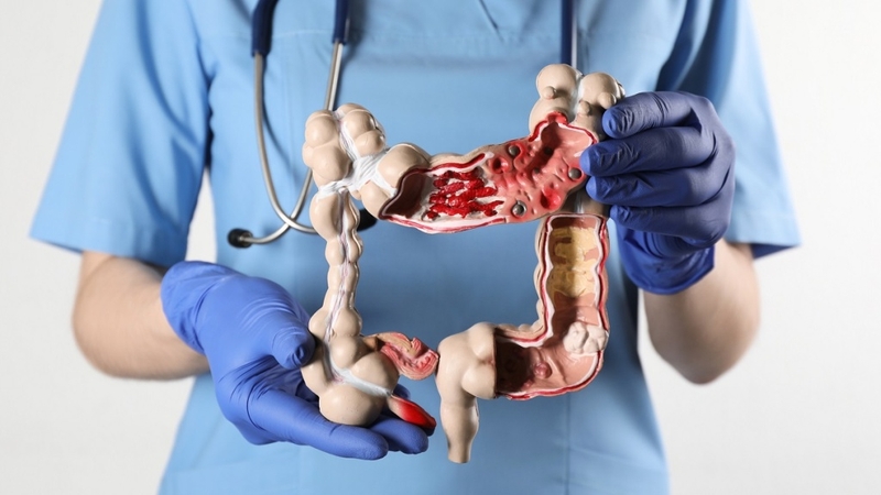 Viêm đại tràng giả mạc và tất tần tật những thông tin bạn cần biết - Hình 2