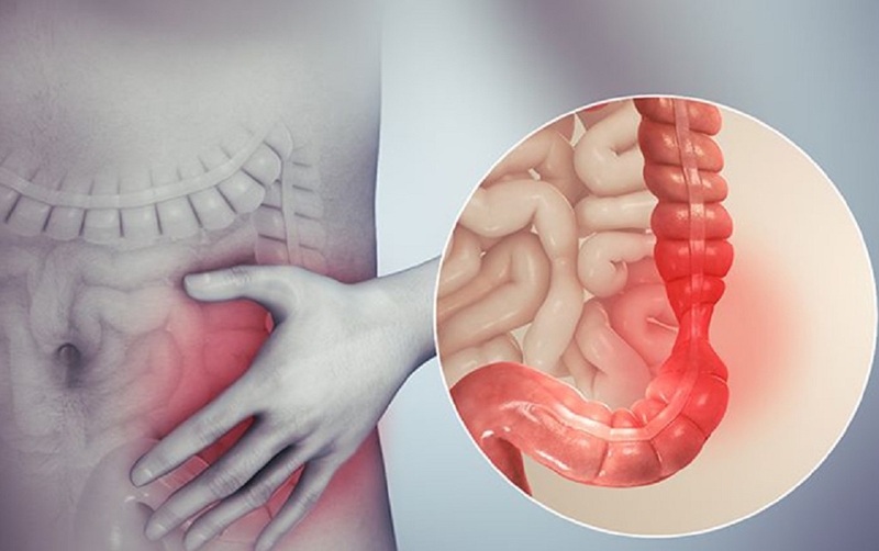 Viêm đại tràng thể táo bón là gì? Nguyên nhân và cách điều trị 1